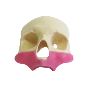 CRÂNIO FRONTAL All-on-4® ZIGOMA COM GENGIVA - cód. 9014G