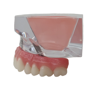 MAXILA ACRÍLICA COM IMPLANTES ANGULADOS E SEIO MAXILAR - cód. 14900