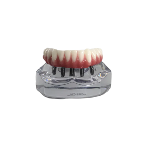 MANDÍBULA ACRÍLICA COM PROTOCOLO E 5 IMPLANTES - cód. 9569