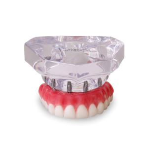 MAXILA ACRÍLICA COM 6 IMPLANTES E PROTOCOLO - cód. 9571