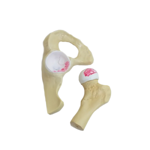 QUADRIL COM OSTEOARTRITE MODERADO - cód. 9598-3